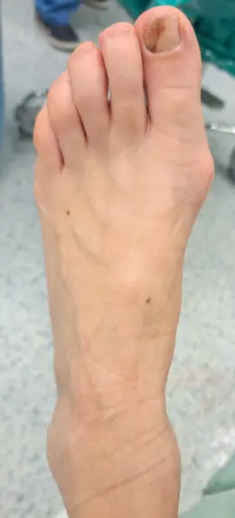 Hammer toes before surgery